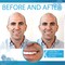 Instant Smile 40 Assorted Temporary Tooth Kit Deluxe 4 Shades Replacement Kit